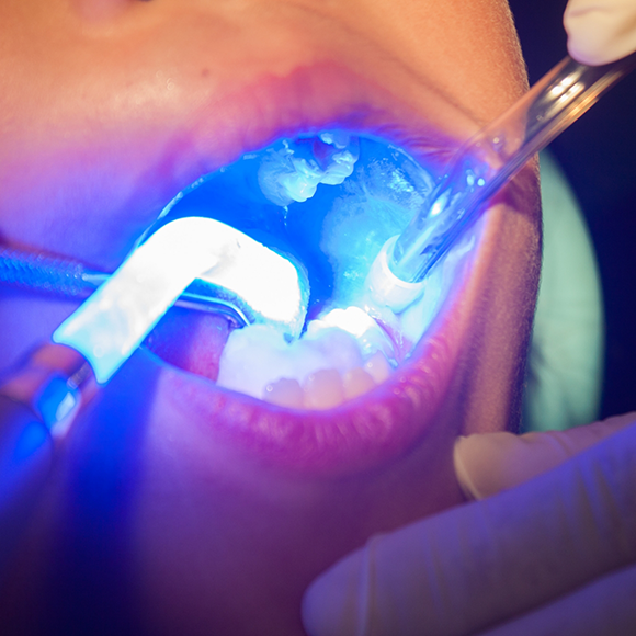 Close up of a patient receiving dental sealants on their teeth