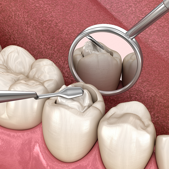 Illustration of dental instruments treating the inner portion of a tooth