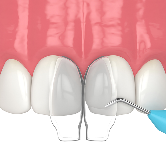 Illustration of dental bonding material being applied to a chipped front tooth