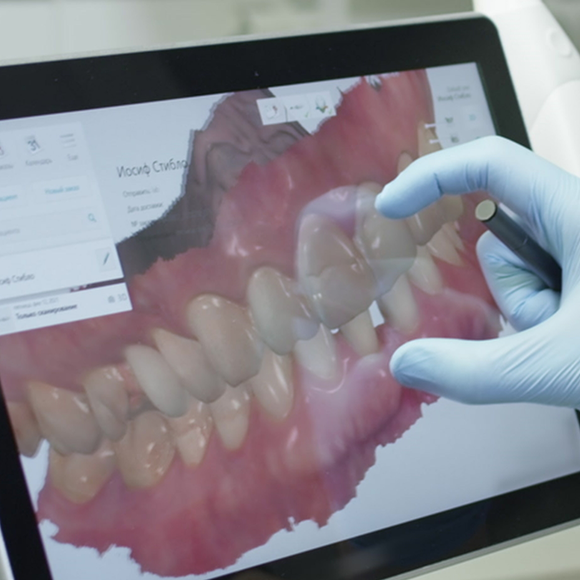 Dentist gesturing to a screen showing digital models of a patients teeth