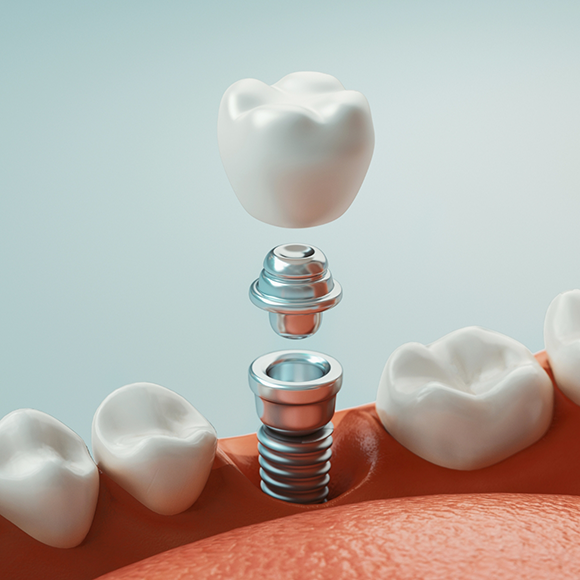 Illustration of a dental implant being placed in the lower jawbone