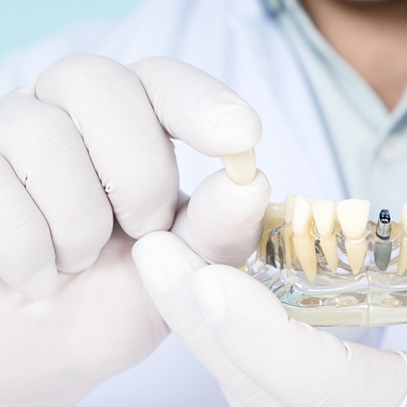 Dentist holding a dental crown and a model of a dental implant