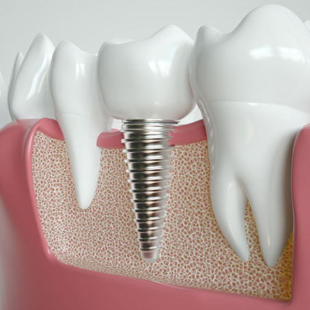 Illustration of a dental implant with a crown replacing one missing tooth