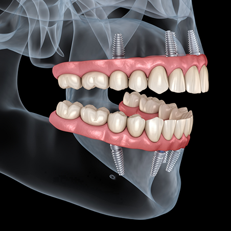 Illustration of a mouth with implant dentures replacing all teeth