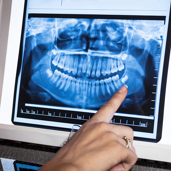 Person pointing to an x ray of teeth