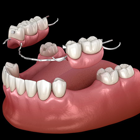 Illustration of a partial denture replacing a few missing teeth along an arch