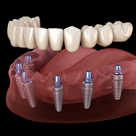 Illustration of six dental implants supporting a full denture