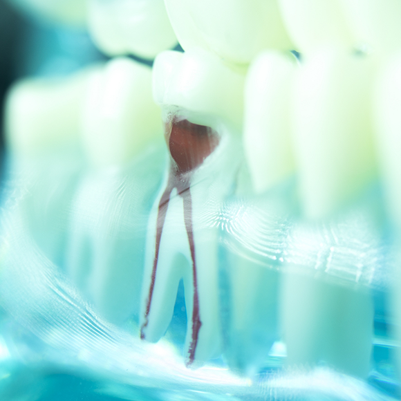 Model of a tooth with the root canals outlined in red