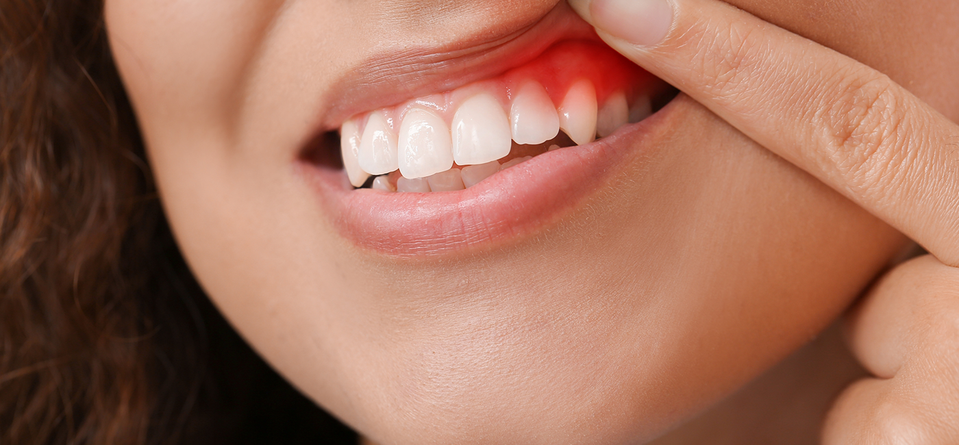 Person pointing to their red gums before gum disease treatment in Altavista