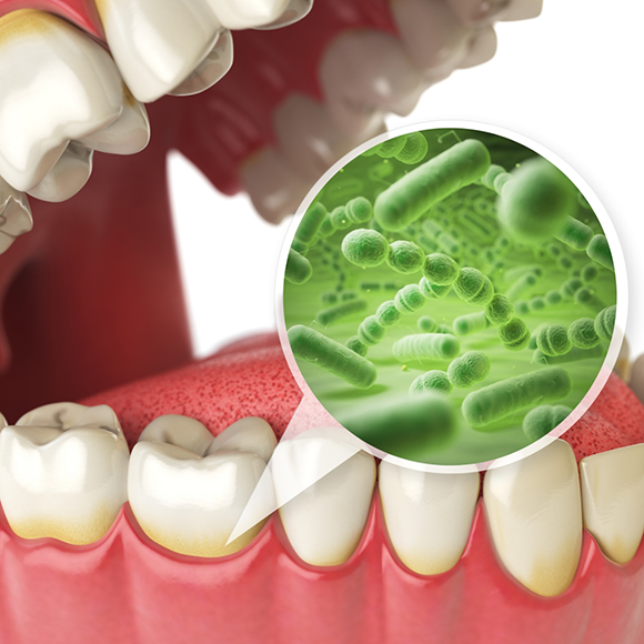 Illustration of infected and receding gums