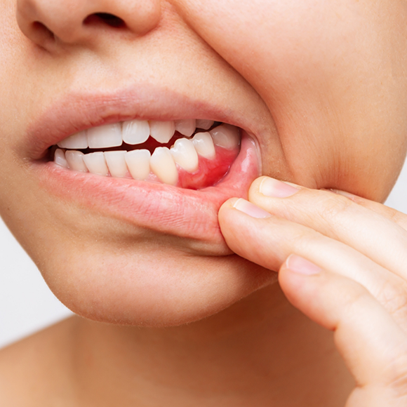 Person pulling down their lower lip to reveal red gums