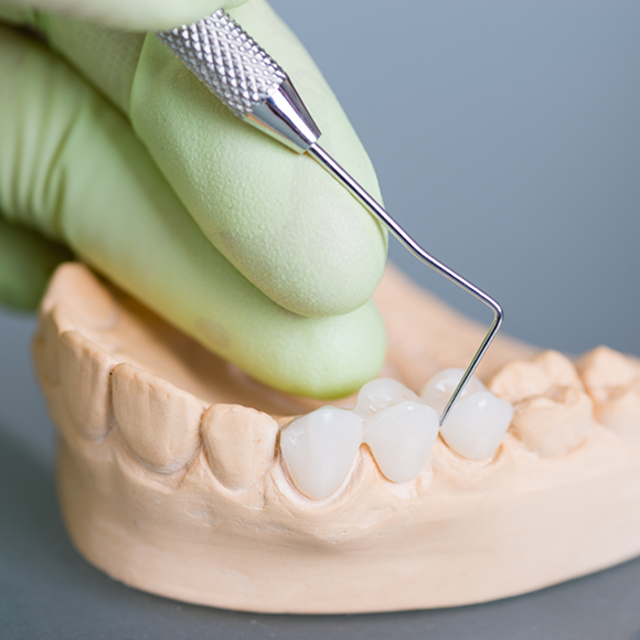 Dental bridge over three of the teeth in a model of the mouth