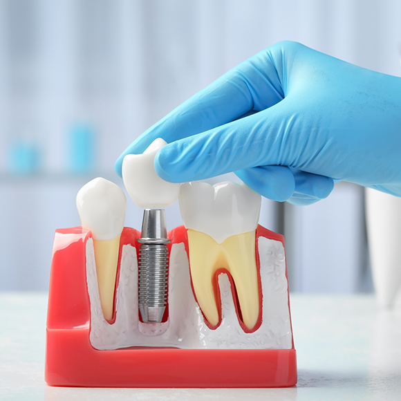 Dentist holding a model of a dental implant