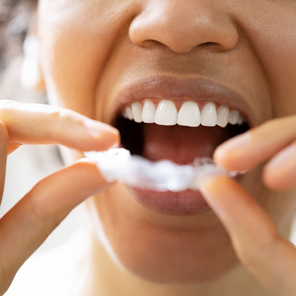 Person placing a nightguard over their teeth