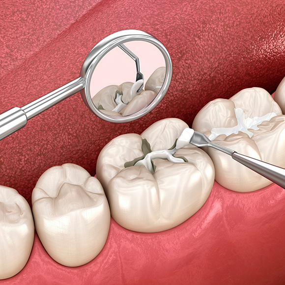 Illustration of a white filling being placed in a tooth