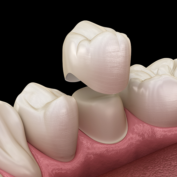 Illustration of a dental crown being fitted over a tooth