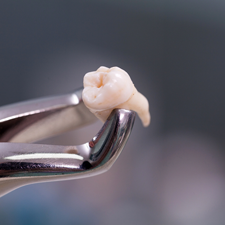 Dental clasp holding an extracted tooth