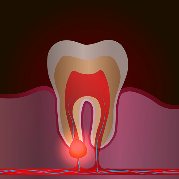 Illustration of an infected tooth that needs root canal treatment