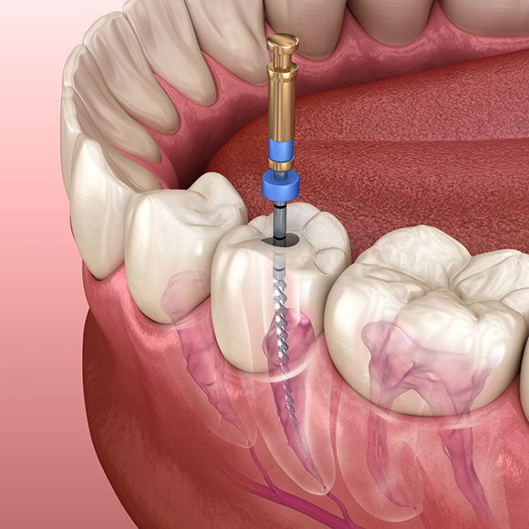 Illustration of a dental instrument treating the innermost layer of a tooth