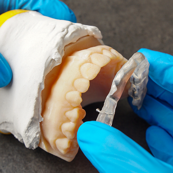 Dentist placing an occlusal splint over a model of an arch of teeth