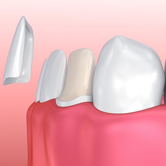 Illustration of a veneer being fitted over a tooth