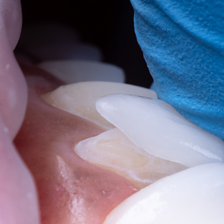 Close up of a veneer being placed over the front of a tooth