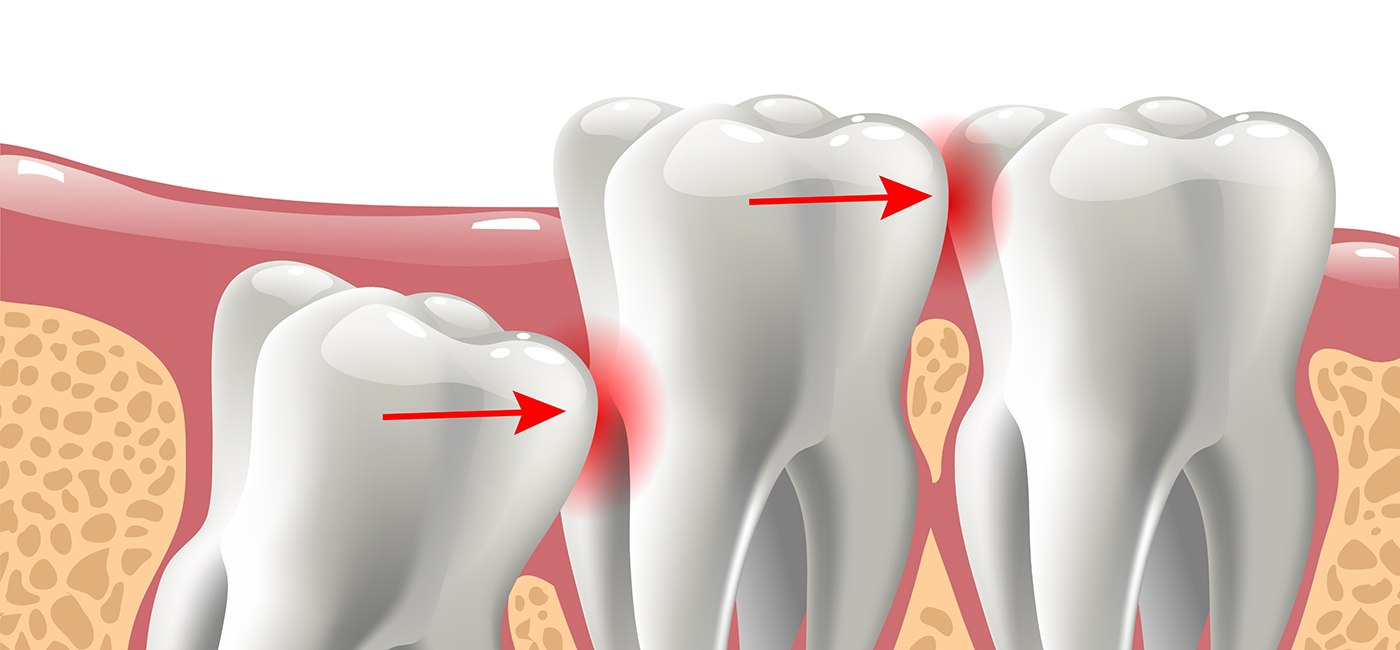 Illustration of an impacted wisdom tooth pressing against the adjacent tooth