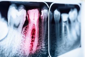 Highlighted tooth infection