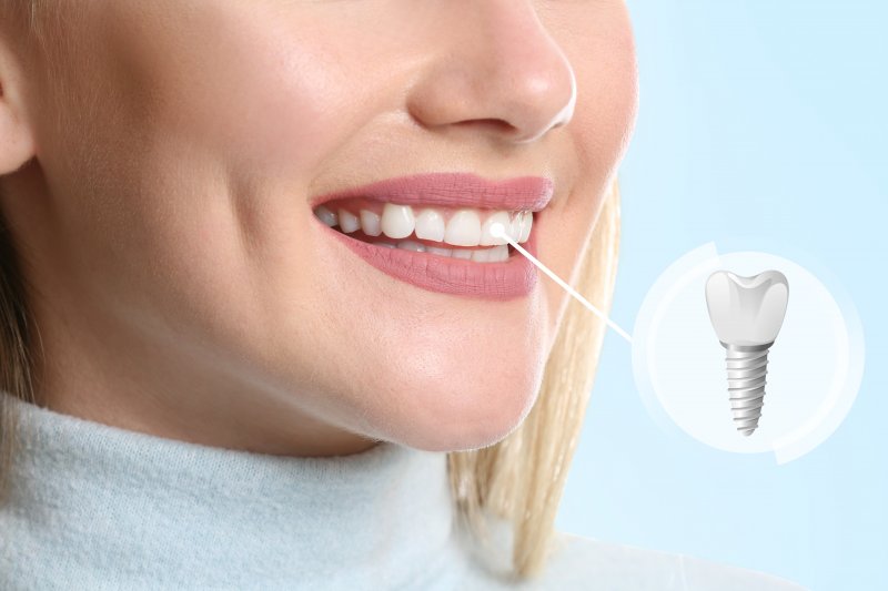 closeup of woman smiling with dental implants