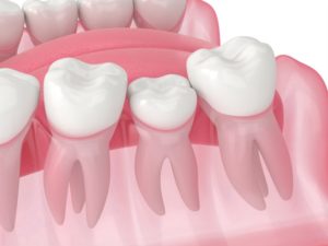 an illustration of teeth that have shifted